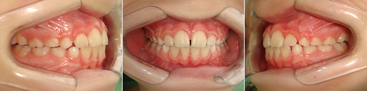 Caso 1 - Apiñamiento Dental y Mordida Cubierta - Imagen Antes