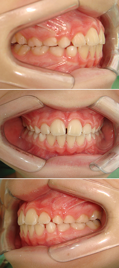 Caso 1 - Apiñamiento Dental y Mordida Cubierta - Imagen Antes
