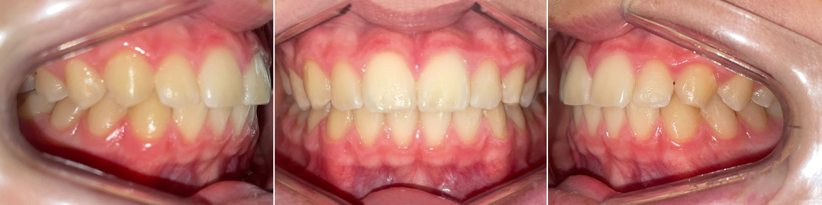 Caso 2 - Mordida Cruzada Unilateral - Imagen Antes