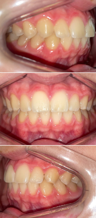 Caso 2 - Mordida Cruzada Unilateral - Imagen Antes