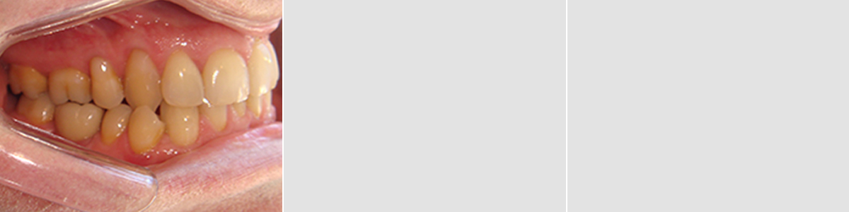 Casos 4 - Mordida Cruzada Unilateral - Imagen Después