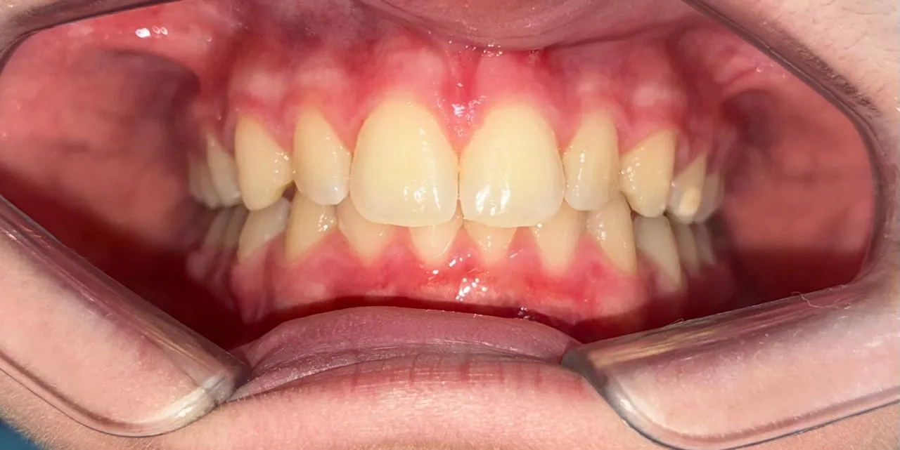 Alineación dentaria y mordida, resultado 1