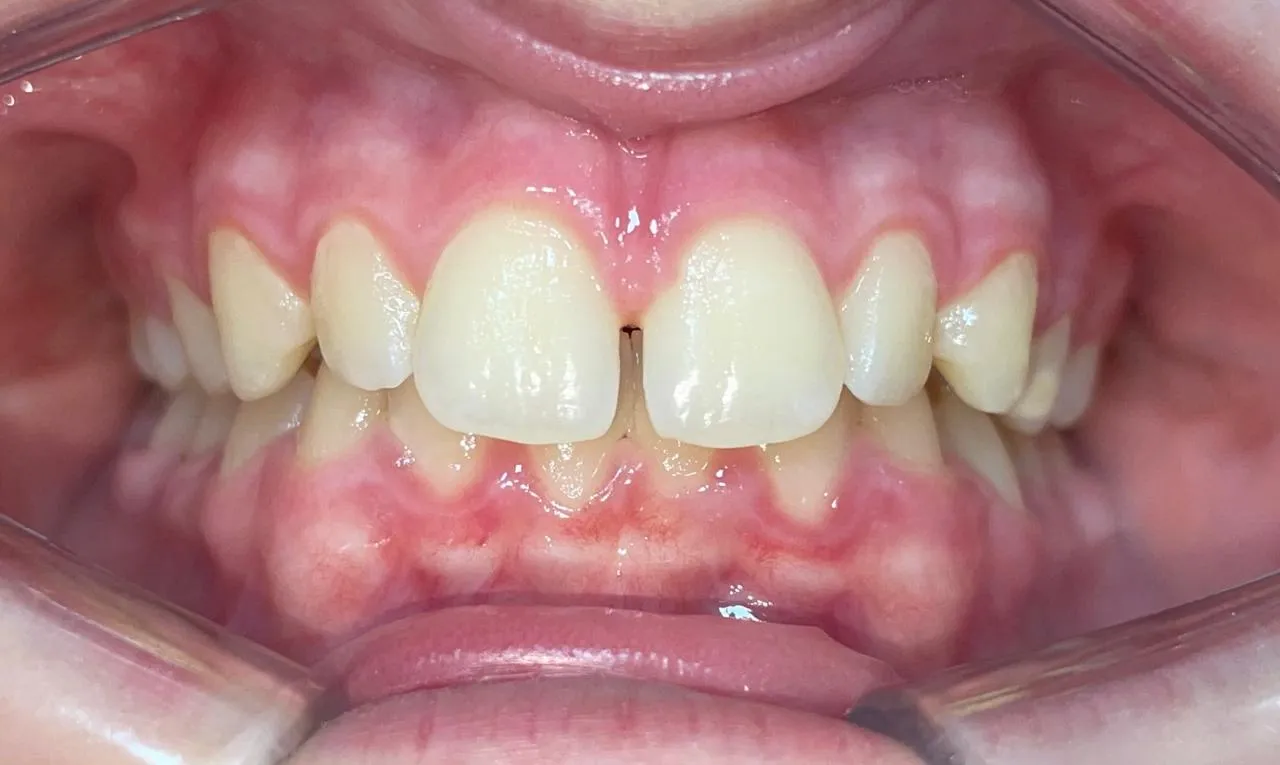 Alineación dentaria y mordida, registro inicial 1