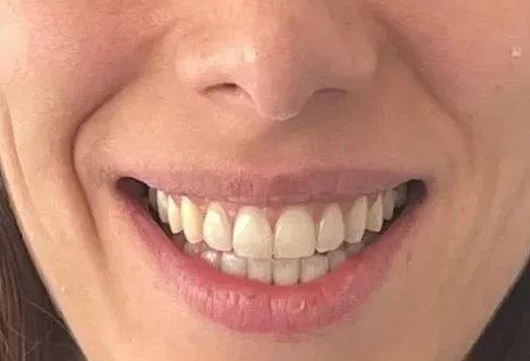 Alineación y estética de la sonrisa, resultado 1