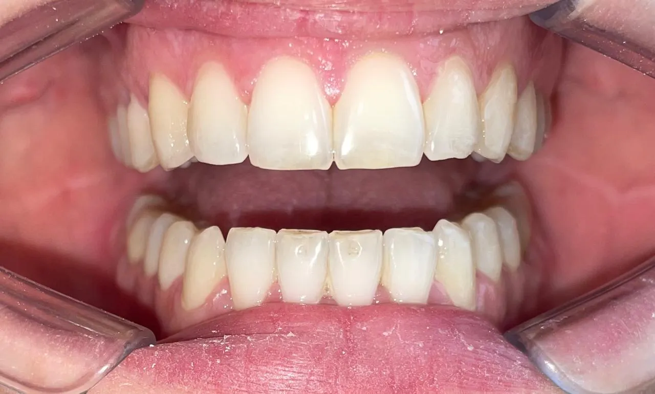 Alineación y estética de la sonrisa, resultado 2