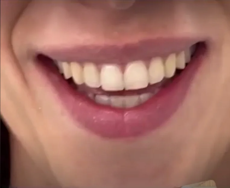 Alineación y estética de la sonrisa, resultado 3