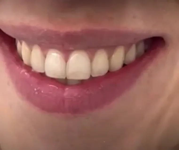 Alineación y estética de la sonrisa, resultado 4