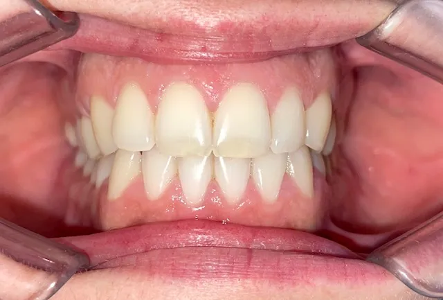 Alineación y estética de la sonrisa, registro inicial 2