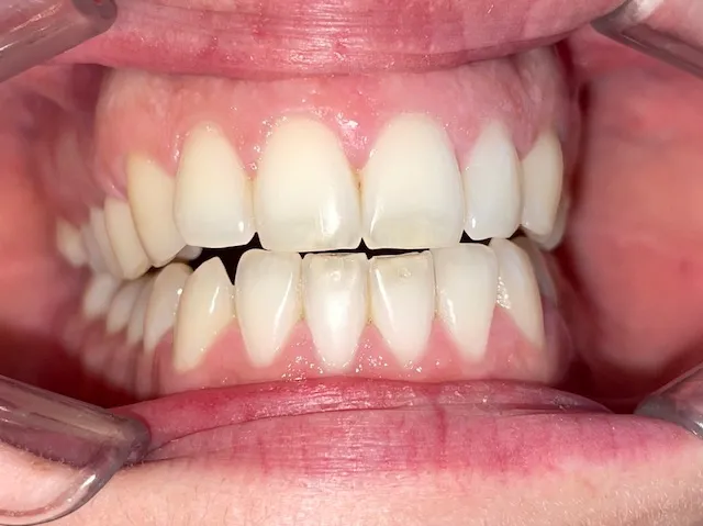Alineación y estética de la sonrisa, registro inicial 3