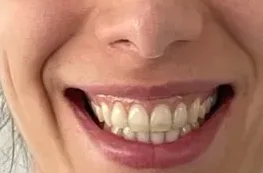 Alineación y estética de la sonrisa, registro inicial 1