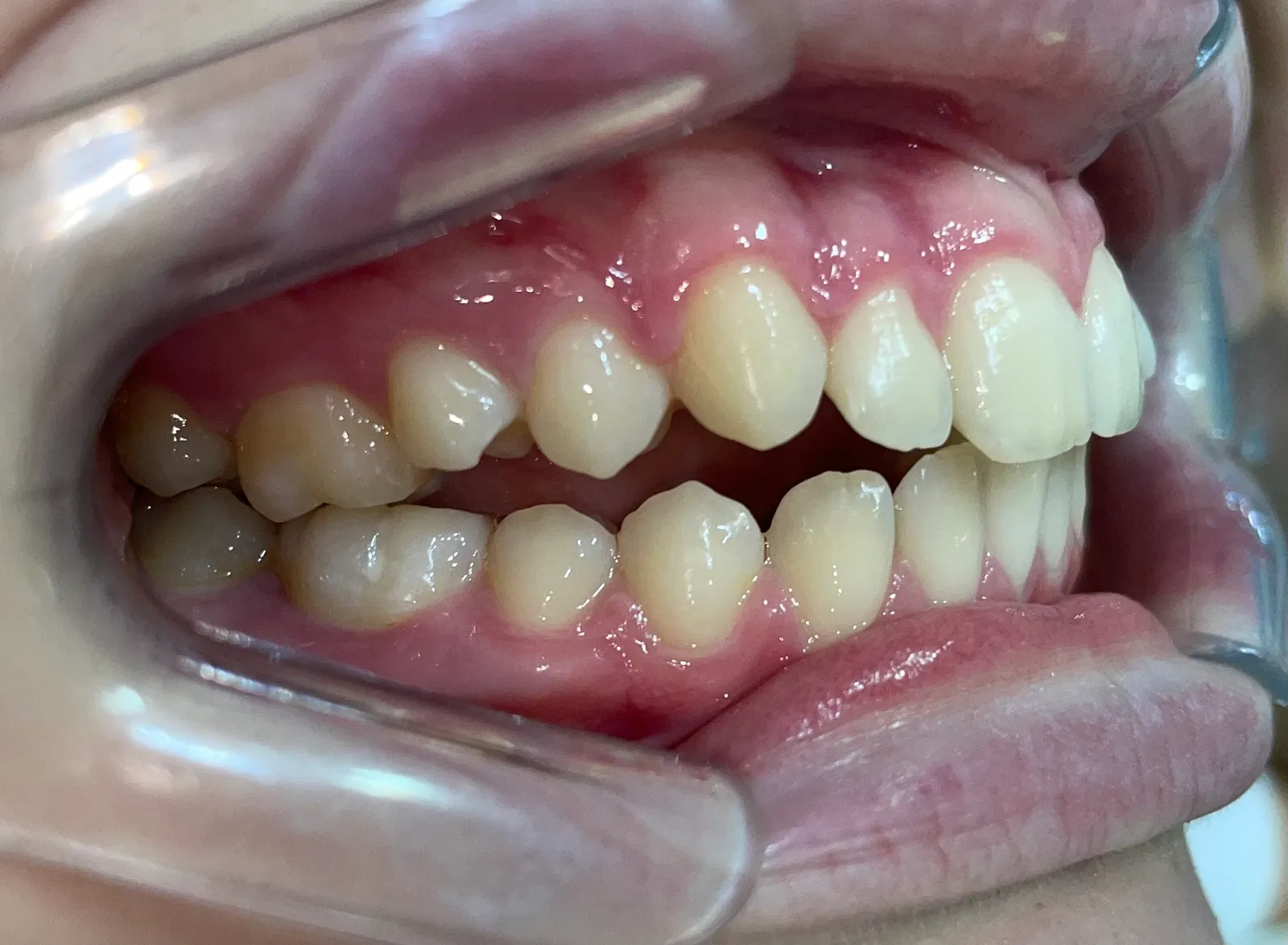 Apiñamiento y mordida abierta anterior, registro inicial 3