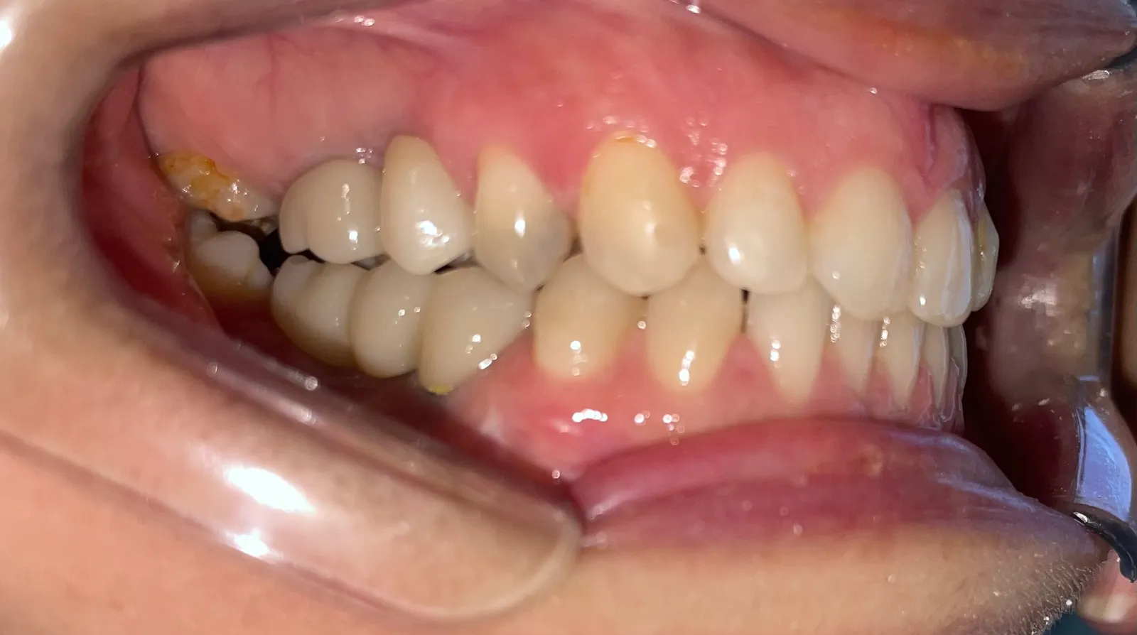 Posición dentaria y relación entre arcadas, resultado 1