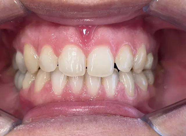 Posición dentaria y relación entre arcadas, resultado 2