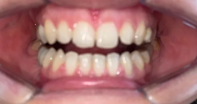 Posición dentaria y relación entre arcadas, resultado 3