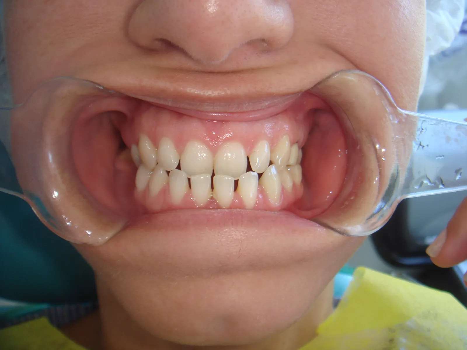 Posición dentaria y relación entre arcadas, registro inicial 1
