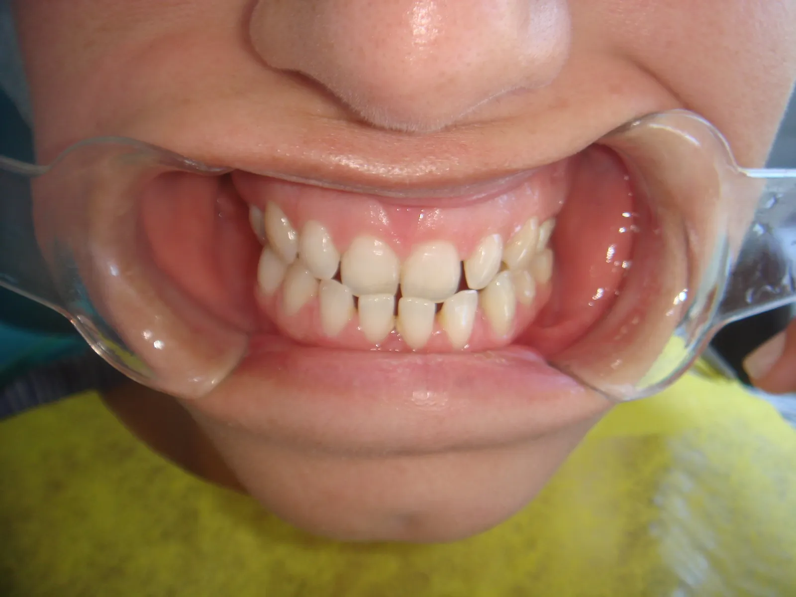Posición dentaria y relación entre arcadas, registro inicial 2