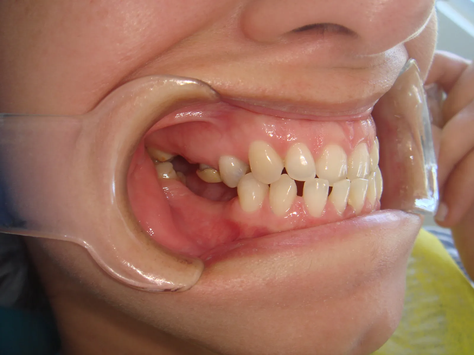 Posición dentaria y relación entre arcadas, registro inicial 3