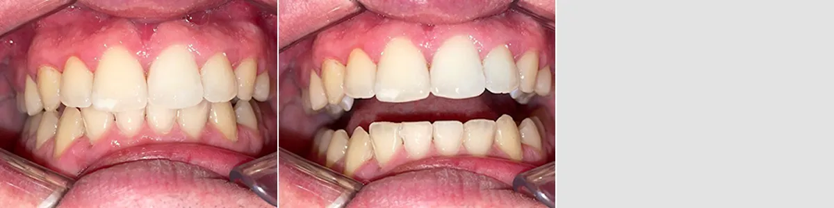 Caso 3, apiñamiento dental, antes