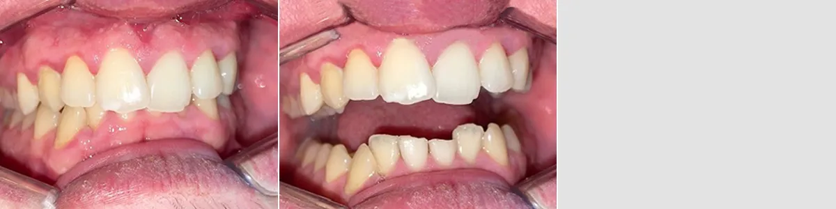Caso 3, apiñamiento dental, después